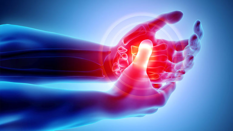 Natural Remedies for Arthritis: A Guide of How to Heal Arthritis
